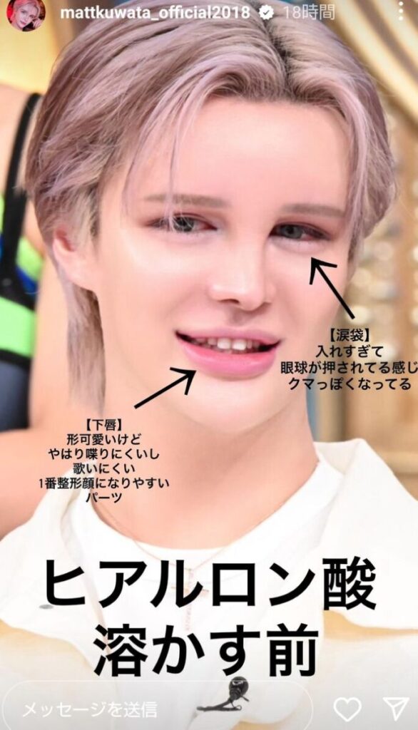Matt整形前の元の顔と現在を比較!昔と今の顔が激変…総額1000万&-16kg | おじトピ